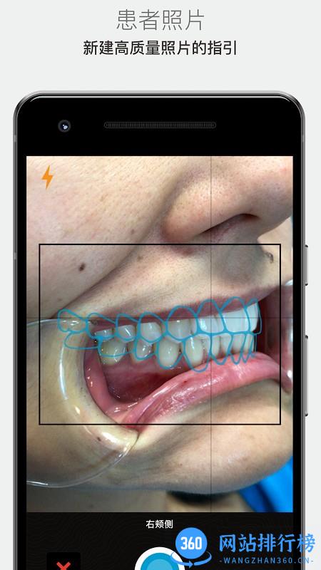 invisalign矫治器(IPU) invisalign矫治器(IPU)